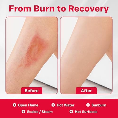 Astroplast First Aid Burns Dispenser in Compact Red Piccolo Box - Refillable First Aid Kit with Burn Gel, Gloves and Burn Dressings - Essential Medical Equipment for Home, Workplace, or Car — view 6