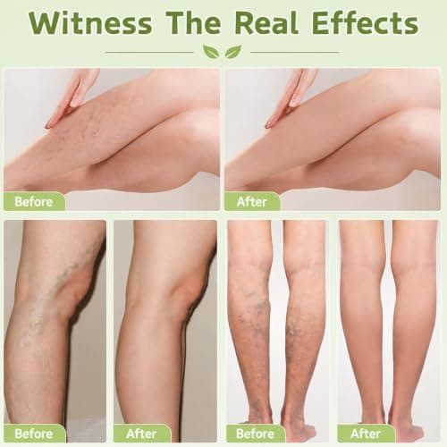 Miracle Balm, Soothing Balm for Legs, Var-icose V-eins Cream with Peppermint & Green Tea, Body Cream to Swelling in Feet and Legs, Natural Ingredients Vegan Skincare (1PCS) — view 2