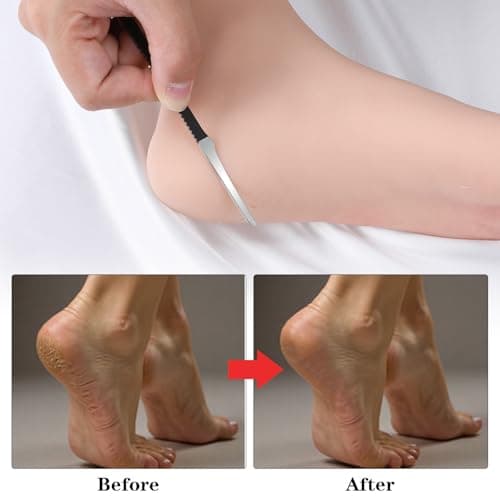 MBAIYO 6 Pack Ingrown Toenail Removal Kit, Professional Pedicure Tools for Ingrown Toenail Callus Shaver Corn Removers for Toes Stainless Steel Nail Knives Kit with Storage Box — view 3