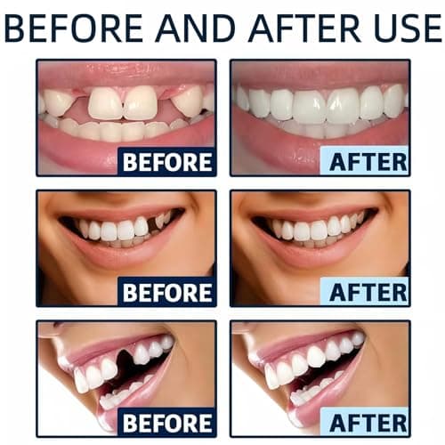 2pcs Soft Denture Silicone Reline Kit,False Teeth Set for Women and Men,Full Mouth Temporary Dentures,Easy to Use,Wide Application,Portable Design,Premium Materials,Soft and Comfortable Design — view 6